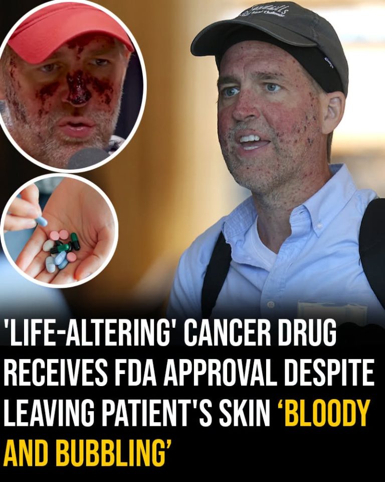 ‘Life-altering’ cancer drug receives FDA approval despite leaving patient’s skin ‘bloody and bubbling’