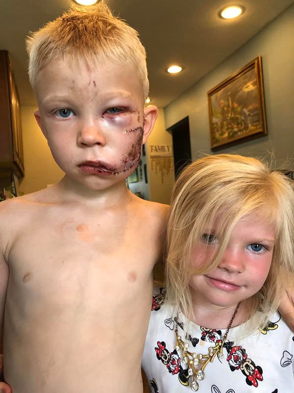 In July 2020, six-year-old Bridger Walker became a hero when he threw himself in front of a charging dog to protect his little sister.